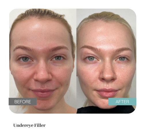 Before and after treatment result — Dr. Lanna, LC Medical Aesthetics NYC